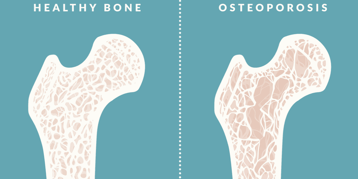 Osteoporosis
