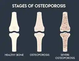 Osteoporosis