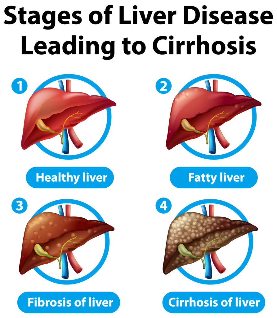 Fatty Liver Diet Plan